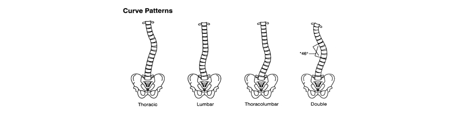 Illustration showing curvature in the thoracic, lumbar, thoracolumbar, regions, and double curvature of the spine