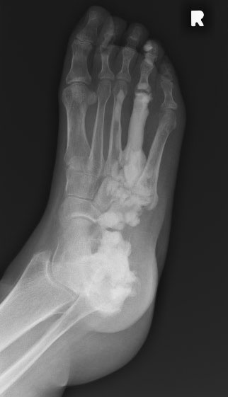 x-ray of right foot.